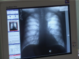 Заболеваемость туберкулезом в  Одесском  регионе остается на стабильно высоком уровне