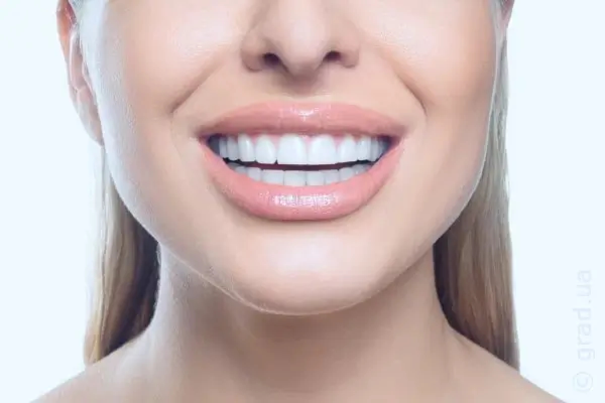 Достоинства установки имплантатов зубов