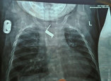 В Одессе у малыша в груди врачи нашли посторонний предмет