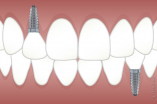 Виды и методы реставрации зубов