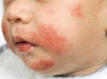 Аллергия может проявиться в любом возрасте: советы врача (видео)