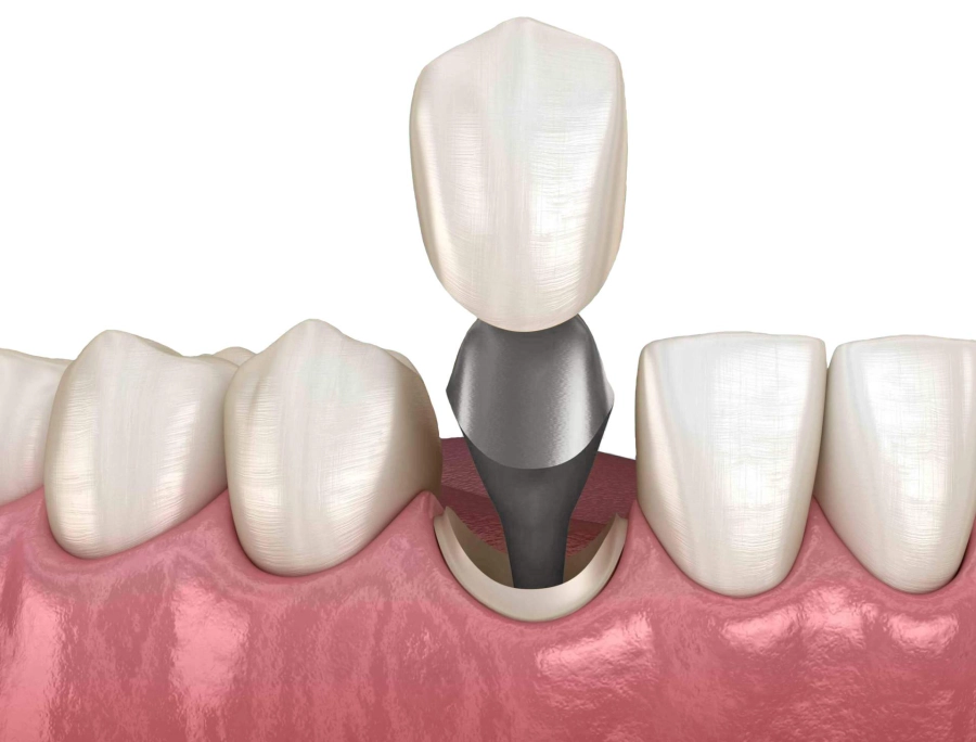 Зубні імпланти ціна