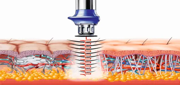 Як працює ударно-хвильова терапія?
